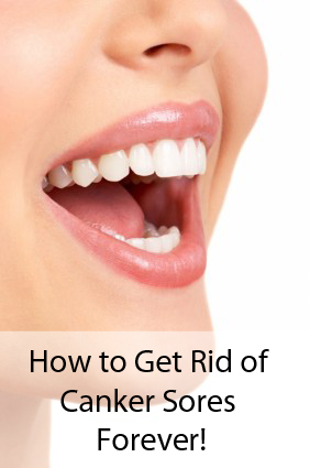 how to get rid of canker sores